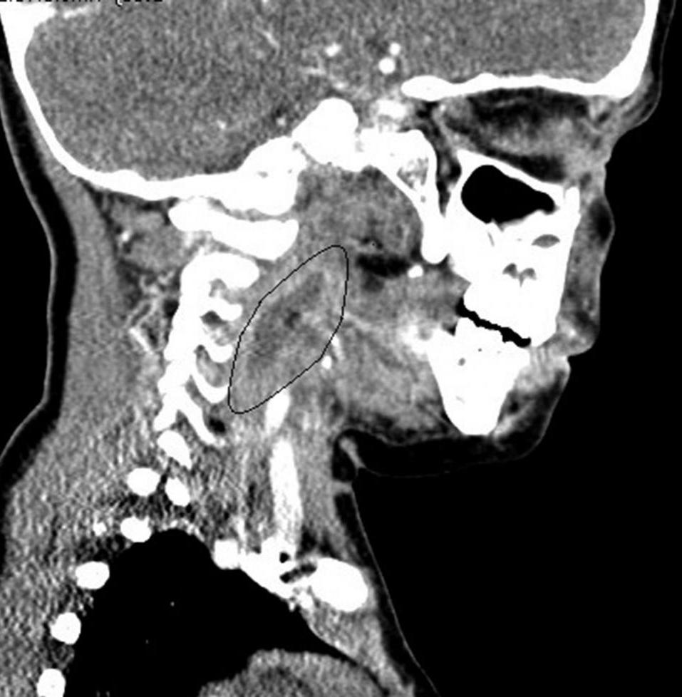 Заглоточный абсцесс. Заглоточный абсцесс кт. Окологлоточный абсцесс кт. Паратонзиллярный абсцесс кт. Параабсцелярный абсцесс.