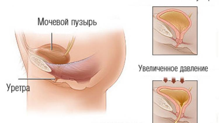 недержание мочи у пожилых