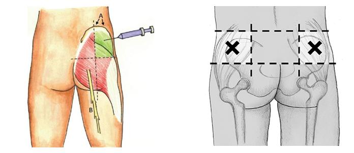 правильно делать укол в ягодицу фото