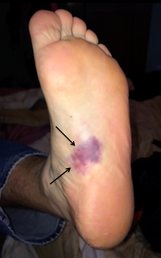 Bruising in the sole of the foot after plantar fascia rupture