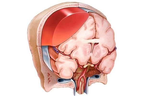гематома мозга