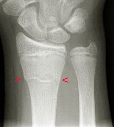 buckle fracture pictures 2