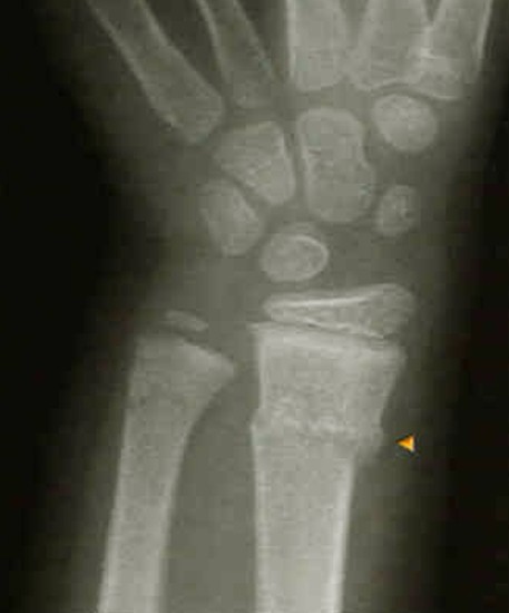 buckle fracture pictures 3