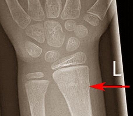 buckle fracture pictures