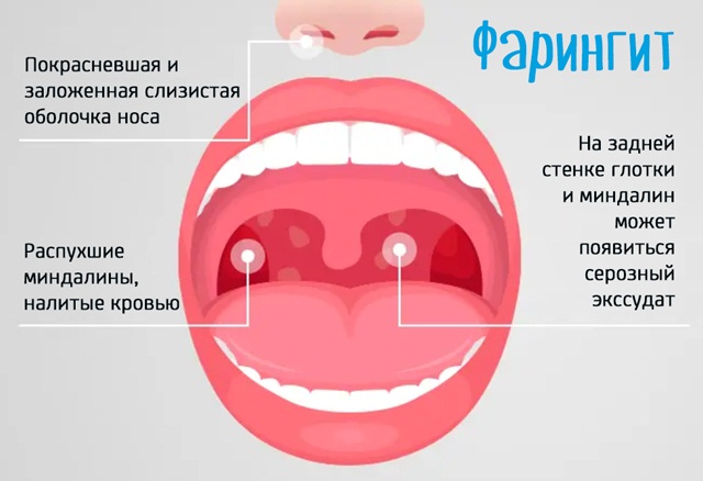 Верхние дыхательные пути. Что это такое, что включают в себя, анатомия, функции, болезни, лечение