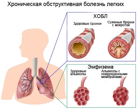 Рестрикция дыхательных путей. Что это такое, спирография, причины и лечение