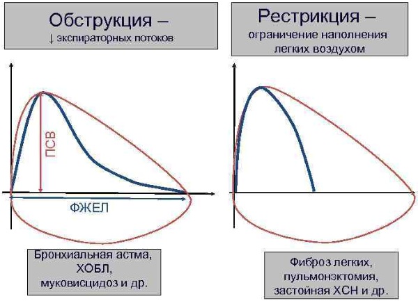 Рестрикция дыхательных путей. Что это такое, спирография, причины и лечение