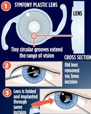 The new technology helps those suffering from longsightedness by inserting a new lens into the eye
