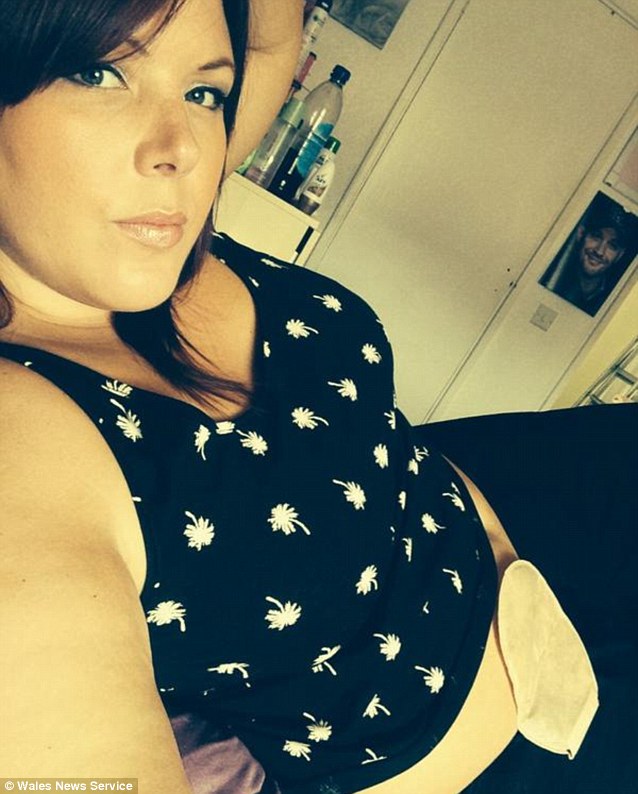 Hundreds of brave women have posted pictures of their colostomy bags on social networking sites such as Facebook