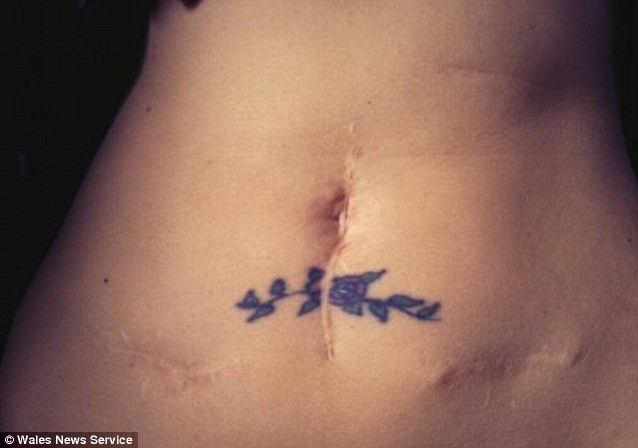 As well as colostomy bags, women are bravely sharing pictures of their scars, often from surgeries for illnesses