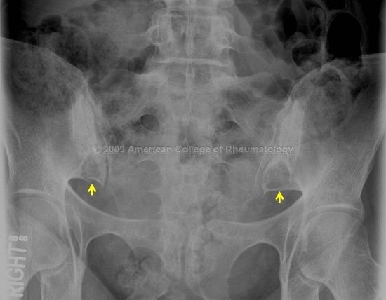 Артроз крестцово подвздошных сочленений. Сакроилеит крестцово-подвздошного сочленения рентген. Артроз крестцово-подвздошных сочленений рентген. Рентген крестцово подвздошных сочленений сакроилеит артроз. Спондилит крестцово подвздошного сочленения рентген.