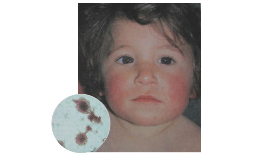 Стрептодермия у детей как начинается фото
