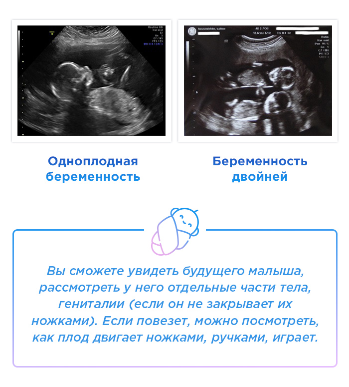 17 недель шевеление плода. УЗИ 17 недель беременности двойня. УЗИ двойни на 18 неделе беременности. 17 Неделя беременности шевеление плода двойня. 18 Недель беременности размер плода.