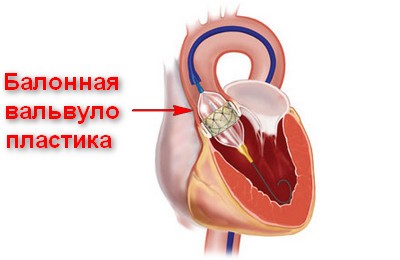 операция при аортальном склерозе