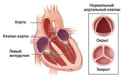 стеноз аорты классификация по градиенту