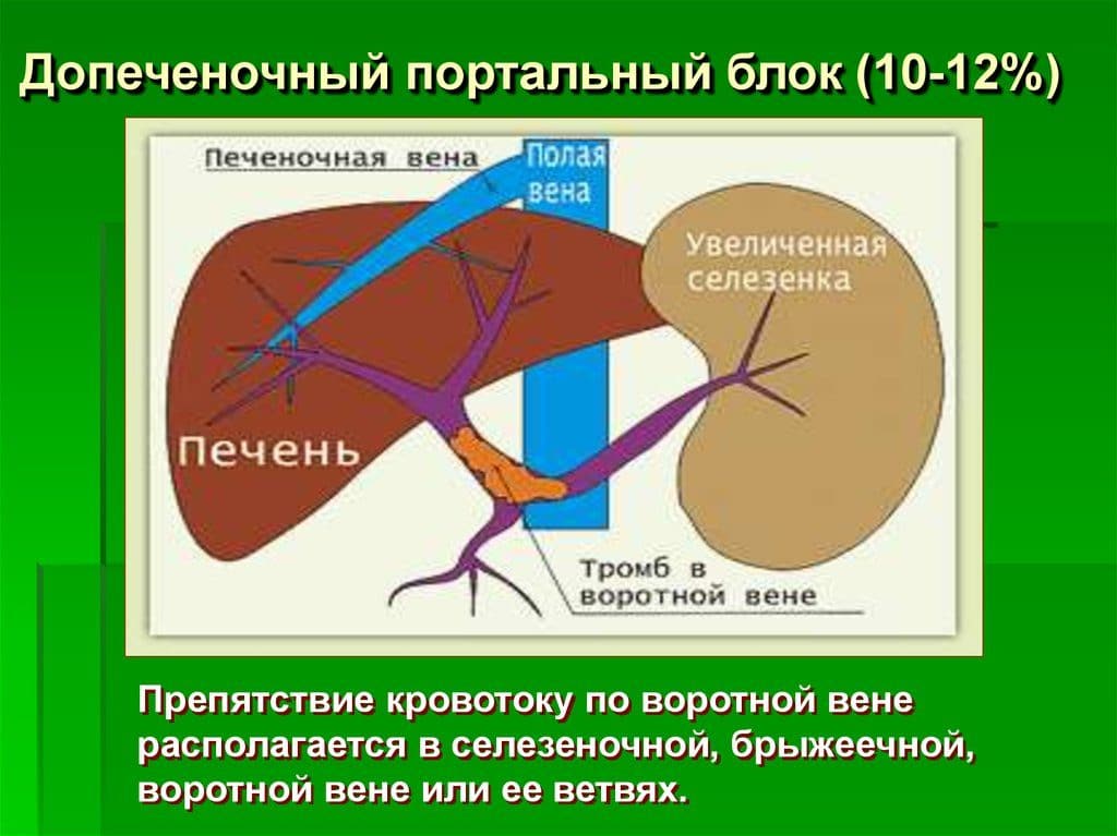 Тромбоза вен печени. Портальная гипертензия подпеченочный блок. Селезеночная Вена диаметр в норме. Портальной гипертензии вены расширения. Портальная гипертензия тромбоз воротной вены.