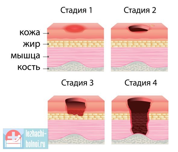 Размер пролежня