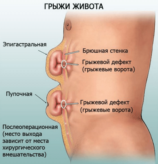 Как вылечить грыжу живота без операции в домашних условиях: методы