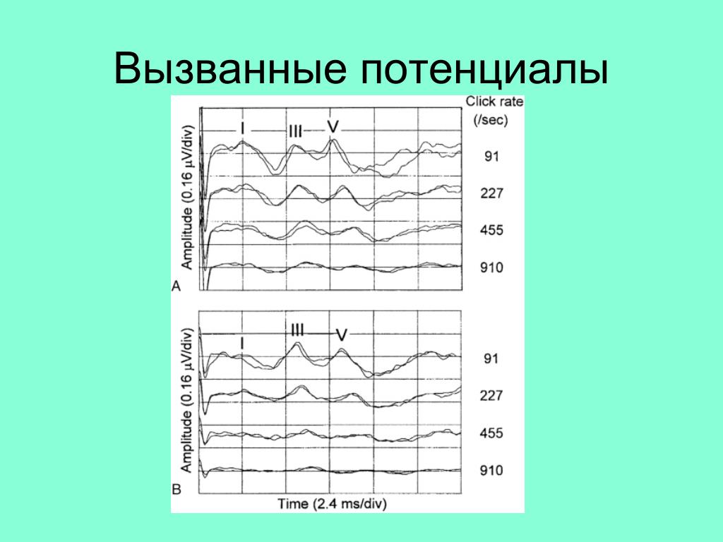 Зрительные вызванные потенциалы