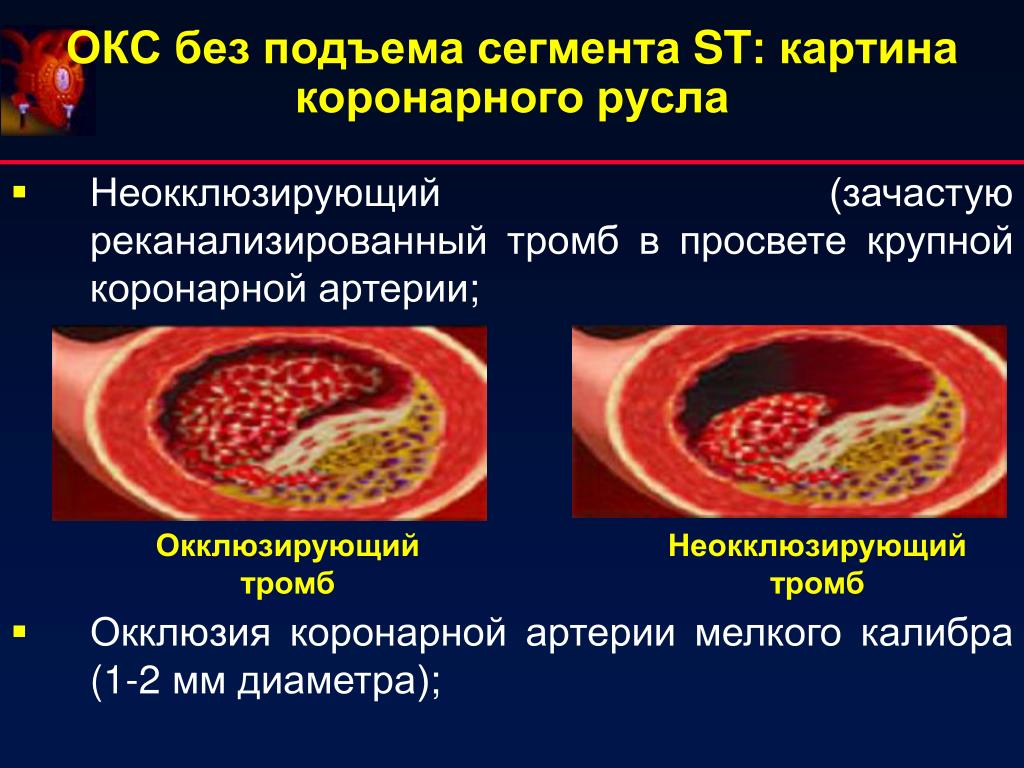 Патогенез острого коронарного синдрома без подъема St. Острый коронарный синдром презентация. Патогенез Окс без подъема St. Острый коронарный синдром с подъемом сегмента St патогенез.