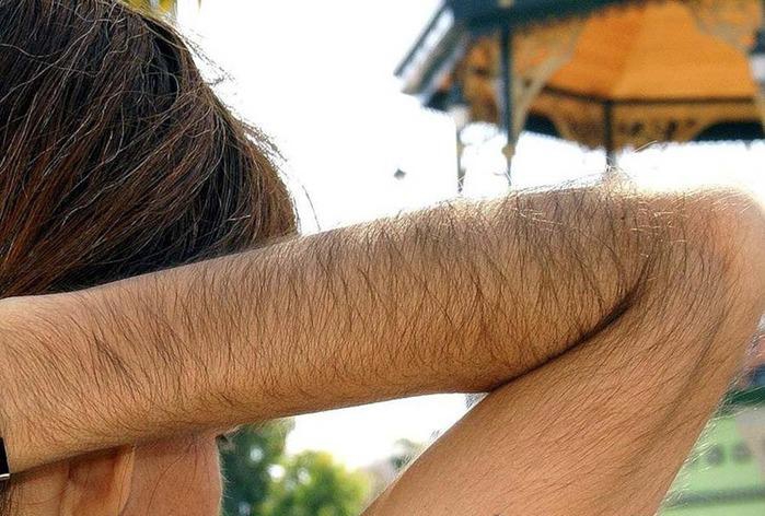 Избыточный рост волос на руках у женщины - это признак гирсутизма