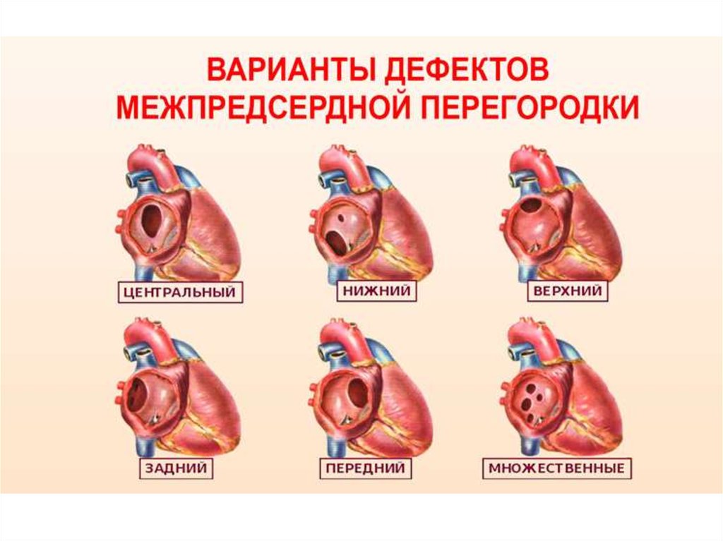 Дефект межжелудочковой перегородки картинки