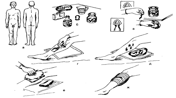 Как проверить правильность наложения влажного согревающего компресса. Согревающий компресс схема. Постановка согревающего компресса алгоритм. Полуспиртовый компресс алгоритм. Постановка холодного компресса.