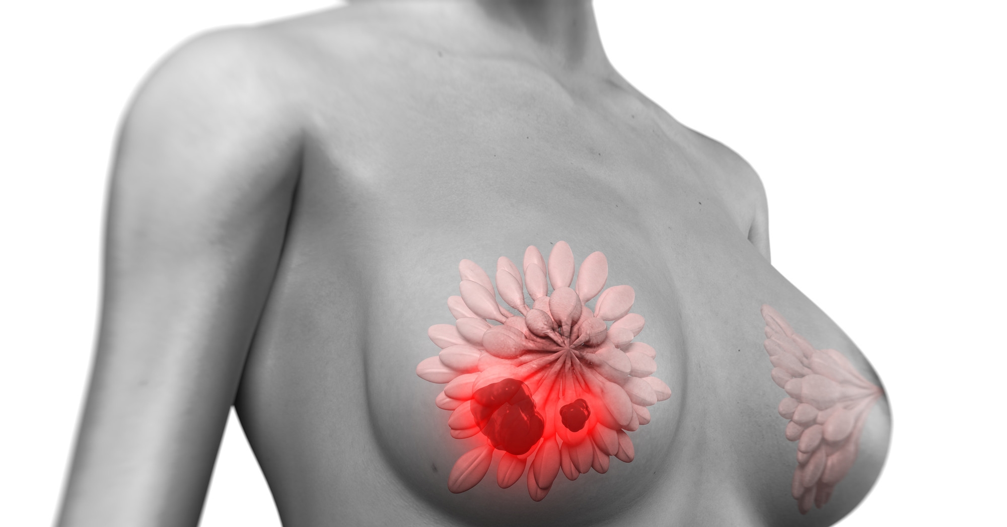 доброкачественные опухоли в груди у женщин фото 60