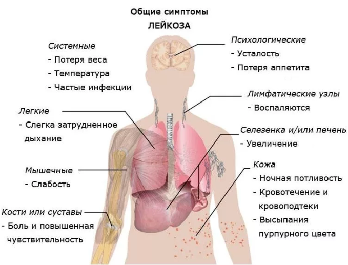 Острый миелобластный лейкоз симптомы, прогноз жизни