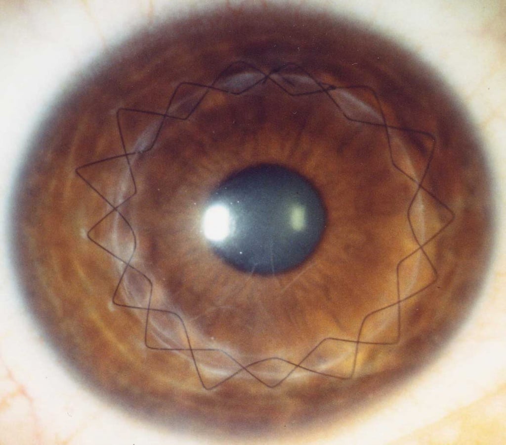 Донор глаза. Кератопротезирование роговицы. Кератоконус роговицы глаз.