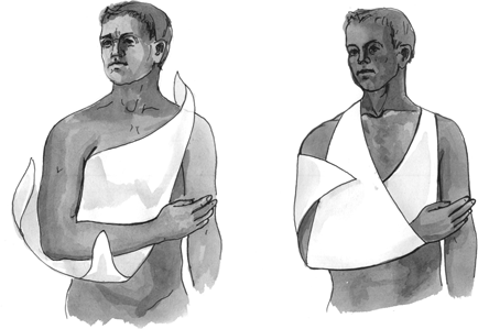 Использование косынки для иммобилизации плечевого пояса и верхней конечности 