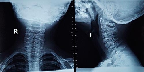Искривление шейного отдела позвоночника и его лечение