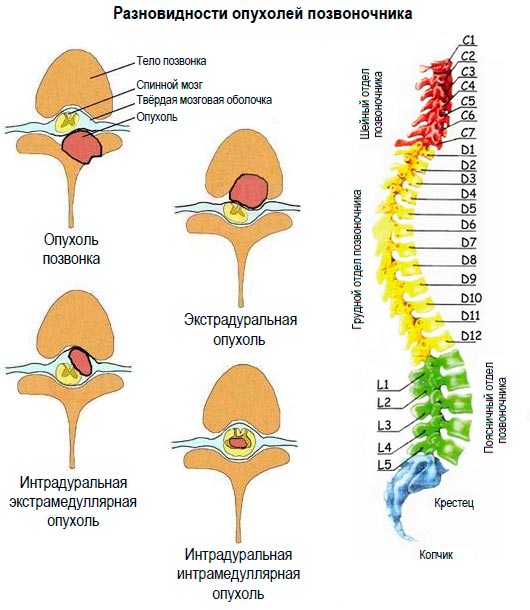 Опухоли спинного мозга