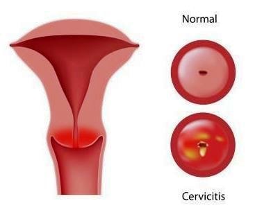 inflamed cervix picture