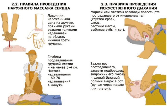 Искусственное дыхание. Как делать, что это, способы, правила, признаки успешного проведения, виды