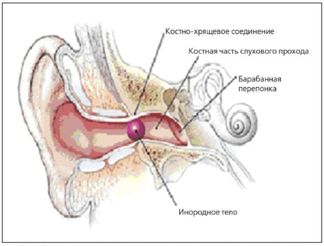 инородное тело уха