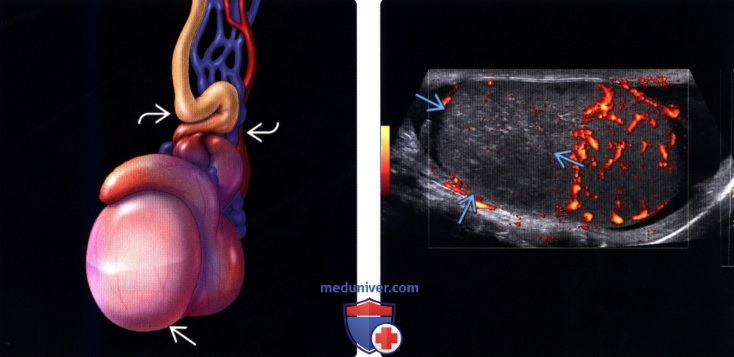 Болит левое яичко причина. Гидатида яичка операция. Гидатида семенного канатика. Перекрут гидатиды операция. Заворот яичка (перекрут семенного канатика).