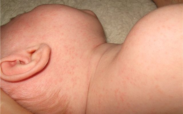 Почему возникает сыпь и температура у ребенка? Разбираемся в тревожащих симптомах