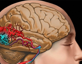 Закупорка сосудов головного мозга