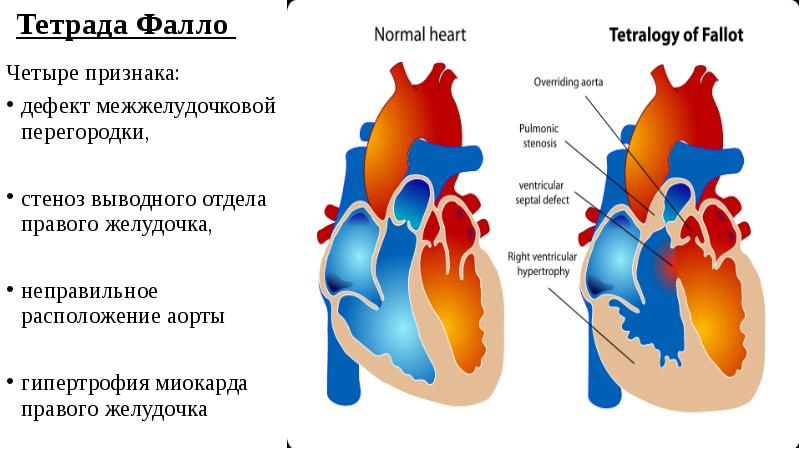 Тетрада фалло