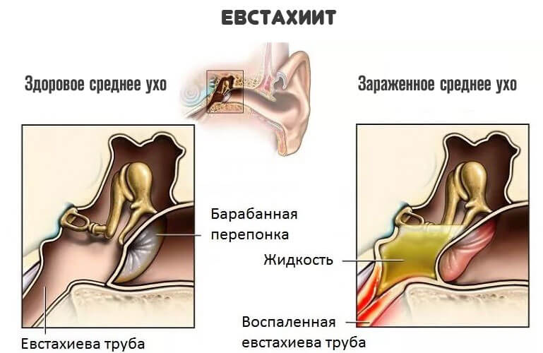 Заложено ухо без температуры. Воспаление слуховой евстахиевой трубы. Евстахиит барабанная перепонка. Гной экссудативный отит. Гнойный отит барабанная перепонка.