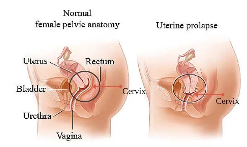 Omission of the uterus