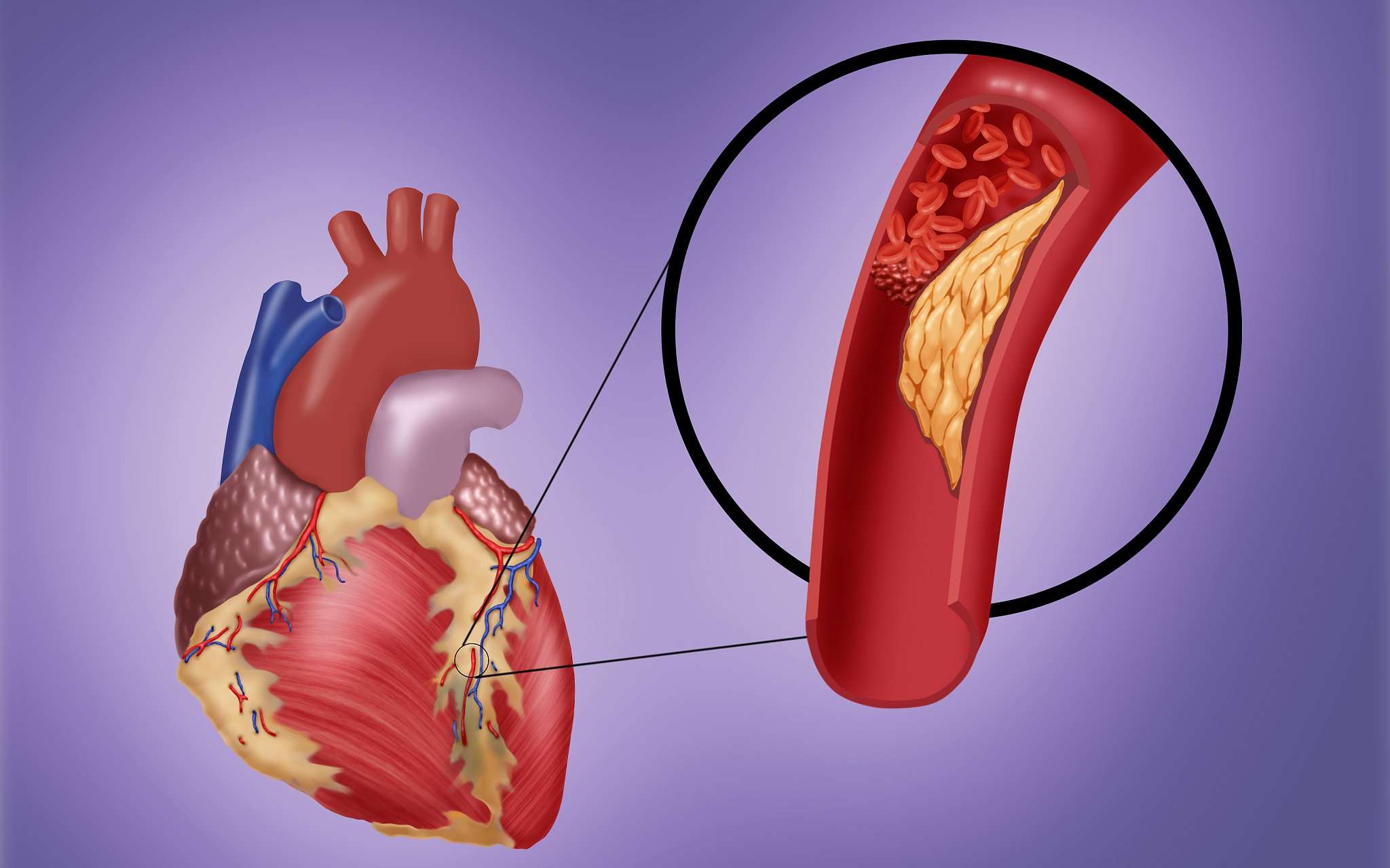 Заболевание атеросклероз. Ишемическая болезнь сердца (ИБС). Атеросклероз коронарных артерий. Коронарная болезнь сердца.