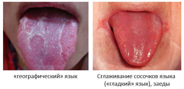 язык при анемии