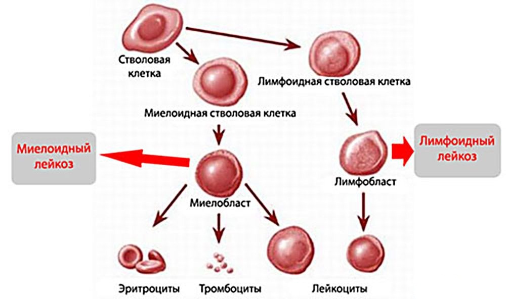 Рак крови: первые симптомы, диагностика, лечение и выживаемость
