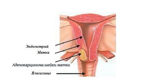 Еще одно женское заболевание – аденокарцинома матки