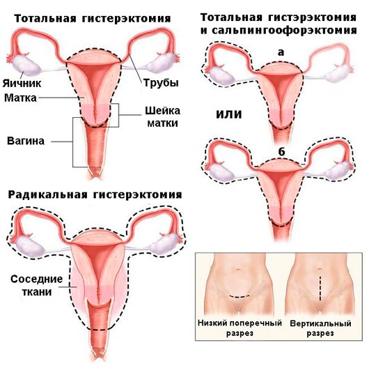 Еще одно женское заболевание – аденокарцинома матки