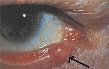 Аденокарцинома глаза