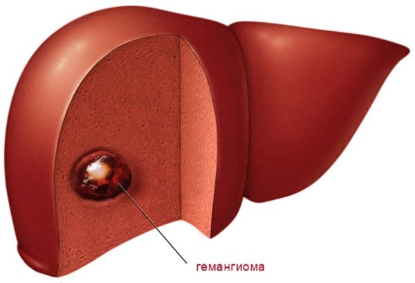 Гемангиома печени