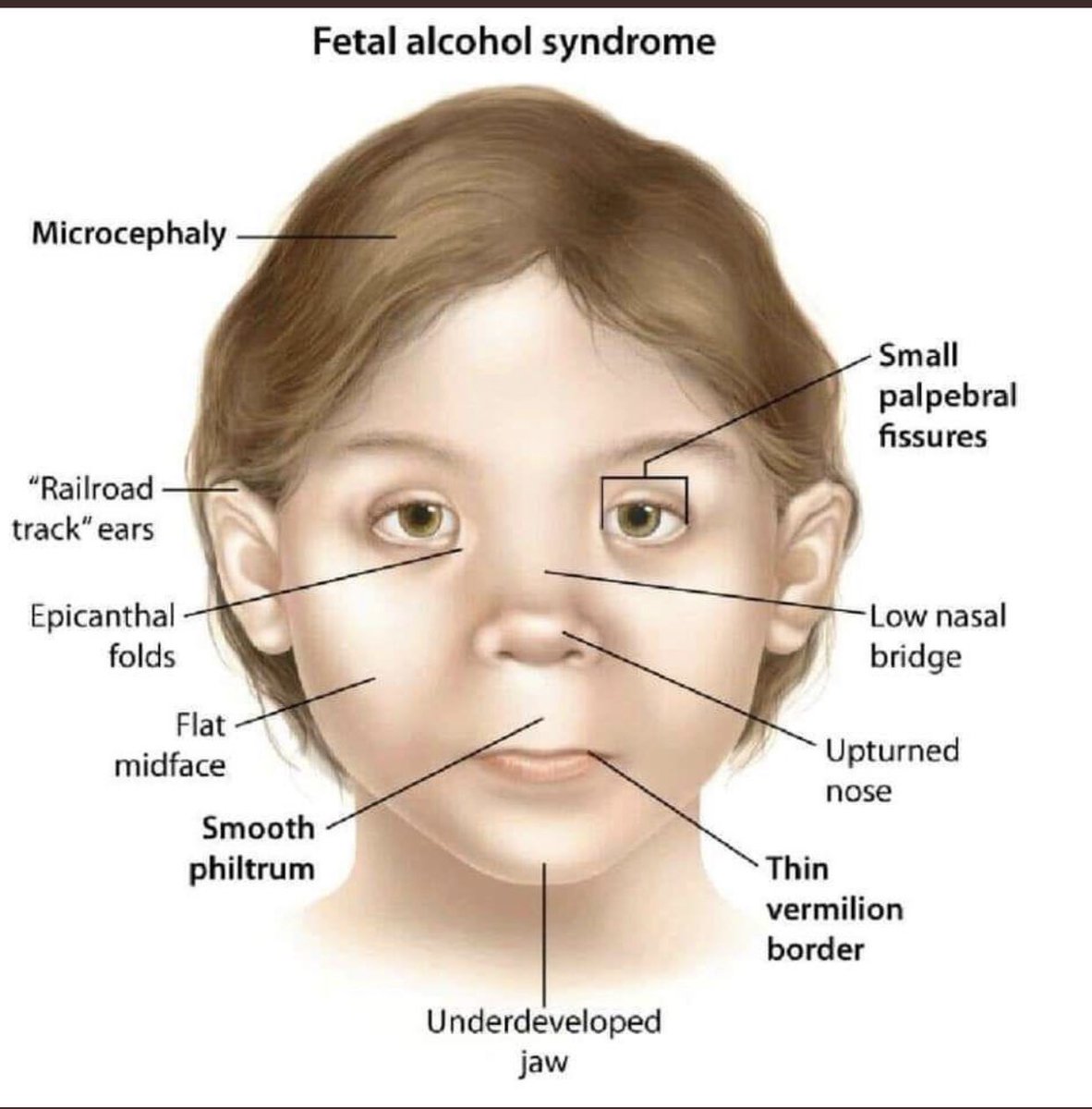 Признаки фетального алкогольного. ФАС фетальный алкогольный синдром. Фетальный алкогольный синдром плода. ФАС фетальный алкогольный синдром у детей. Фестивальный алкогольный синдром.